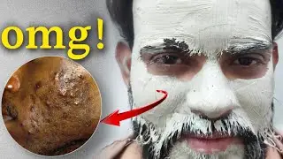 I Used The Aztec Healing Clay Mask On My Skin Everyday For One Week