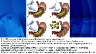 A new endoscopic tangential sawing technique for the treatment of giant bezoars