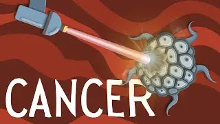 How lasers are used to treat cancer