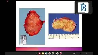 8) linfoma de hodking