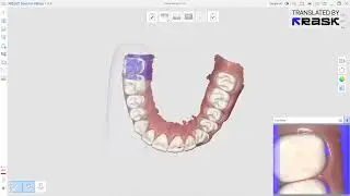 Medit App  Designing temporary with digital wax up ESP