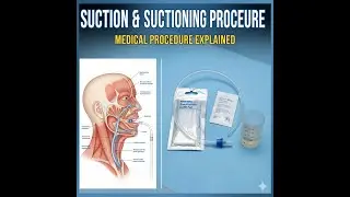 Suction | Suctioning Procedure | Suction Pressure