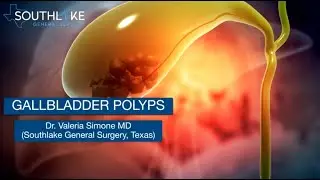 Gallbladder Polyps &ndash; Causes, Symptoms & Treatment