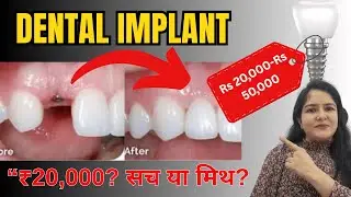 Dental Implant procedure.Tooth implant meaning. Dental implant cost in india #dentalimplants #dental