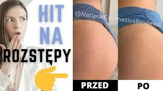 Rozstępy - jak się ich pozbyć