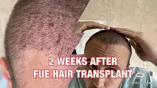 DAY 14 after FUE Hair Transplant in Istanbul, Turkey 🇹🇷 (3500 grafts - Front & Crown) 🇬🇧