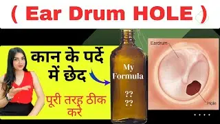 कान के पर्दे में छेद &mdash; Ear Drum Hole ..? 👉My Best COMBINATION..;;
