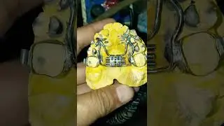 Hyrax Appliance #Palatal #expander#dentalartbyhaider