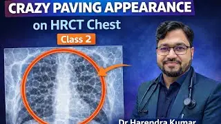 Crazy Appearance on HRCT chest - Classes 2 #hrct #pulmonologist #radiology 