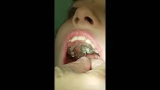 OkunOrtho- Turning the key on a palatal expander