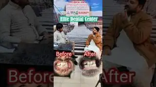 My Teeth Treatment | Scaling by Elite Dental Center | Dr Ghulam Ahmed Abbasi #gashahvlogs #dentist