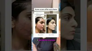 Do I have acne scars after accutane? #skincare #acne #accutane #skincareroutine #antiacne