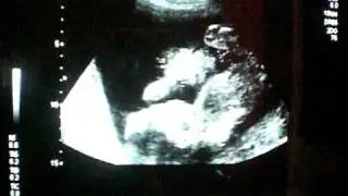 20 weken echo/20 weeks ultrasound