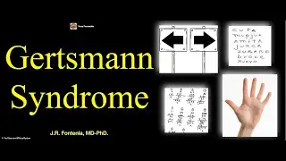 S&iacute;ndrome de Gertsmann: Agrafia, Agnosia Digital, Acalculia, Desorientaci&oacute;n derecha-izquierda.