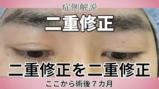 男性の二重修正 症例解説／幅狭く～手術後７か月 動画あり