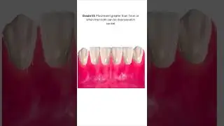 Mobility Grading #shorts #short #dental #dentist #teeth #dentistry
