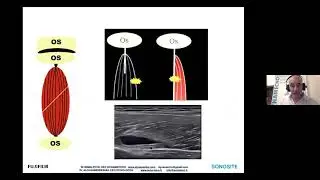 Echographie et traumatismes musculaires aigus chez le sportif le quadriceps