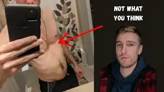 Living with Pectus Excavatum
