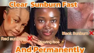 Sunburn treatment creams for face  ✅ | How to clear sunburn permanently 