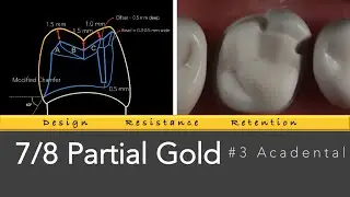 7/8 Gold Partial Veneer #3 Acadental | Gold Coverage Restoration