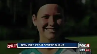 Layne Chesney, teen who was badly burned in bonfire, dies at 15