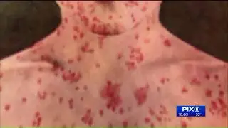 Measles exposure reported in Suffolk County, Long Island