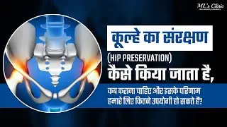 #hippreservation कूल्हा संरक्षण क्या है? हिप प्रिजर्वेशन सर्जरी हिंदी में | Joint Preservation #hip