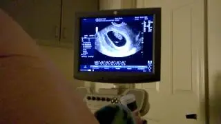 9 week ultrasound of the Twins!