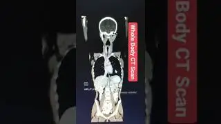 Whole Body CT Scan #shorts #youtubeshorts #viral