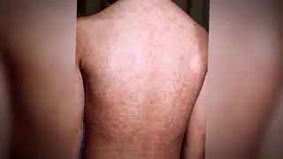 Medical experts recommend measles vaccine