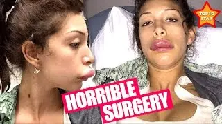 Actresses who looks horrible post cosmetic surgery!