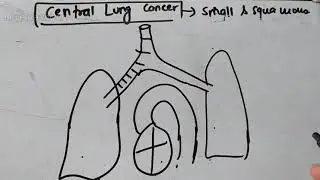 Lung Cancer :(Small cell and squamous cell carcinoma) part 1