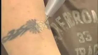 Laser Tattoo Removal with the MedLite C6