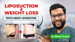 Thinking of Liposuction to Lose Weight? WATCH THIS FIRST! ⚠️
