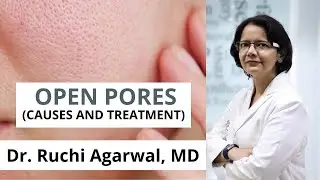 How to Treat Open Pores? Causes | Treatment | Satya Skin Clinic Delhi