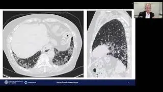 W46 Deep Learning driven Image Search and Speed up of Thorax CT Assessment by H.Prosch and G.Langs