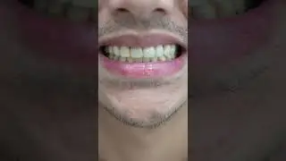 Archie Alemania's new smile! 🧡💚