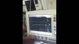NIPPV Servo I