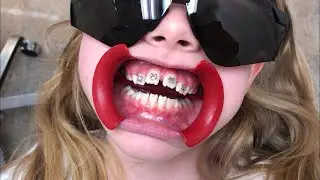 Finally Getting Braces On!!!