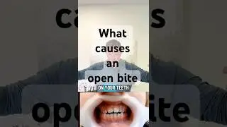 What causes an open bite #openbite #braces #thumbsucking #pacifier #newmom