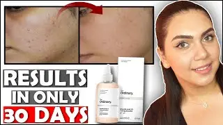 How to clear acne in 30day with only $7 - Honest review by Shakila