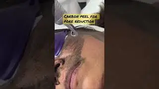 Carbon peel for pore reduction #pores #carbonpeel #porereduction #nopain #olimpiacarmen