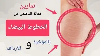 تخلصي من الخطوط البيضاء بالمؤخرة والأرداف ( لن تصدقي النتيجة )
