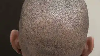 African American Male FUE by San Francisco Hair Transplant