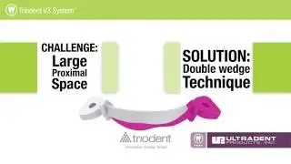 Triodent V3 System: Double Wedge technique