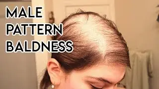 Treating Male Pattern Baldness