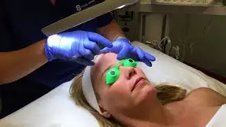 Benefits of Dermaplaning