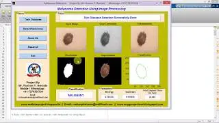 Skin Cancer Detection Using Matlab Code !! IEEE Based Project