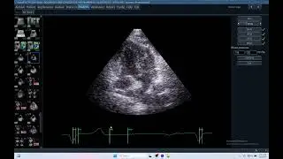 IQ 411 GWE MYOCARDIAL WORK EFFICIENCY  ECHOPAC ANALYSIS ECHOCARDIOGRAPHY SEVEROUS DYSSYNCHRONY,DOG