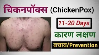Chickenpox / Symptoms / Causes In Hindi / चिकनपाॅक्स (छोटी माता)/chicken pox
